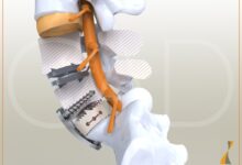Medical illustration showing a detailed view of a lumbar spine with a prosthetic disc implanted, highlighting the advanced technology and surgical precision involved in lumbar disc replacement."